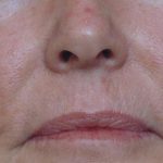 Red Spot Before & After Patient #1045