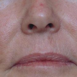 Red Spot Before & After Patient #1045