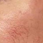 Red Spot Before & After Patient #1046