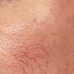 Red Spot Before & After Patient #1046