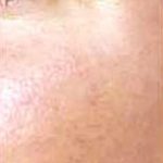 Red Spot Before & After Patient #1046