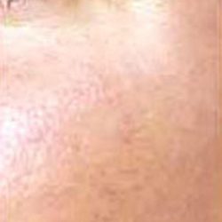 Red Spot Before & After Patient #1046