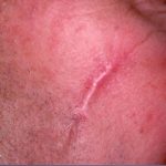 Red Spot Before & After Patient #1047