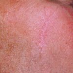 Red Spot Before & After Patient #1047