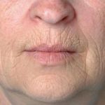 Rejuvenation Before & After Patient #1048