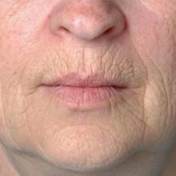 Rejuvenation Before & After Patient #1048