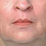 Rejuvenation Before & After Patient #1048