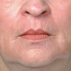 Rejuvenation Before & After Patient #1048
