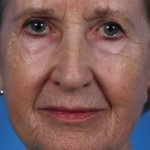 Rejuvenation Before & After Patient #1049