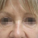Skin Tightening Before & After Patient #1051