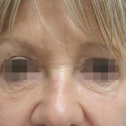 Skin Tightening Before & After Patient #1051