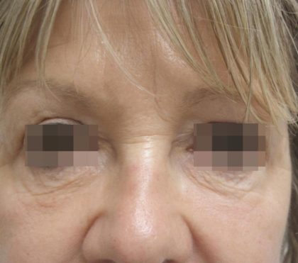 Skin Tightening Before & After Patient #1051