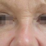 Skin Tightening Before & After Patient #1051