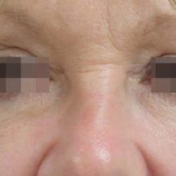 Skin Tightening Before & After Patient #1051