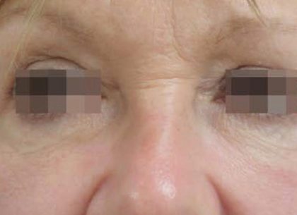 Skin Tightening Before & After Patient #1051