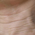 Skin Tightening Before & After Patient #1052