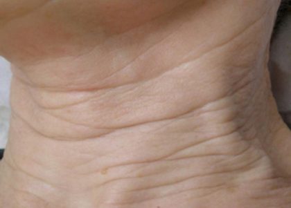 Skin Tightening Before & After Patient #1052