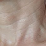 Skin Tightening Before & After Patient #1052