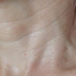 Skin Tightening Before & After Patient #1052