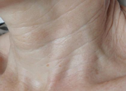 Skin Tightening Before & After Patient #1052