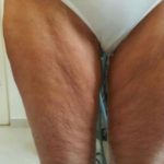 Skin Tightening Before & After Patient #1053