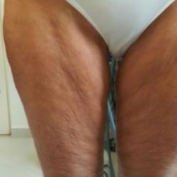 Skin Tightening Before & After Patient #1053