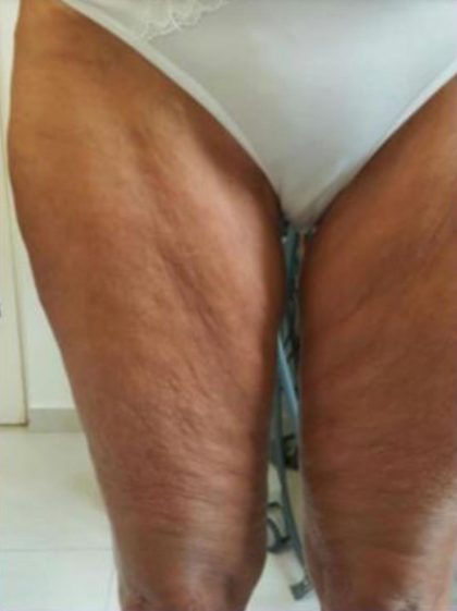 Skin Tightening Before & After Patient #1053
