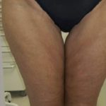 Skin Tightening Before & After Patient #1053