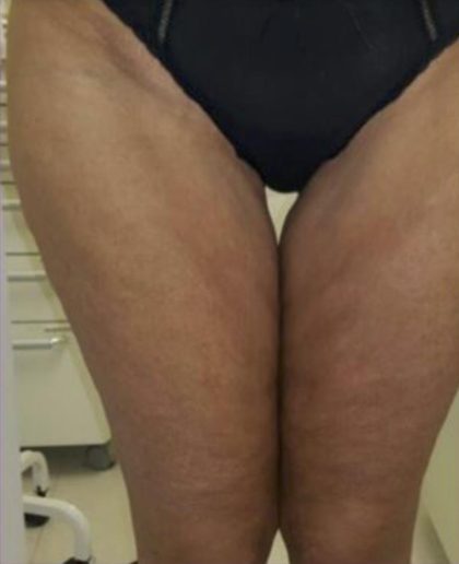 Skin Tightening Before & After Patient #1053