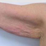 Skin Tightening Before & After Patient #1054