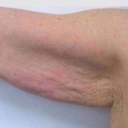 Skin Tightening Before & After Patient #1054