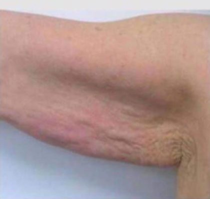 Skin Tightening Before & After Patient #1054