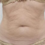 Skin Tightening Before & After Patient #1055