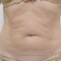 Skin Tightening Before & After Patient #1055