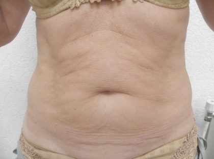Skin Tightening Before & After Patient #1055