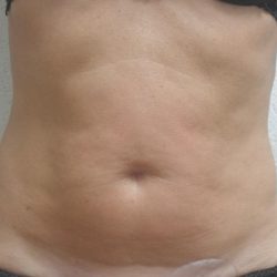 Skin Tightening Before & After Patient #1055