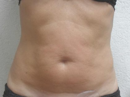 Skin Tightening Before & After Patient #1055