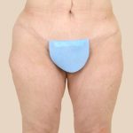Thigh Lift Before & After Patient #1056