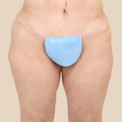 Thigh Lift Before & After Patient #1056