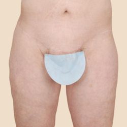 Thigh Lift Before & After Patient #1056