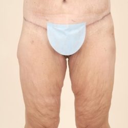 Thigh Lift Before & After Patient #1057