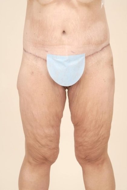 Thigh Lift Before & After Patient #1057