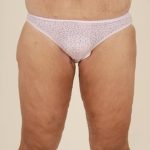 Thigh Lift Before & After Patient #1057