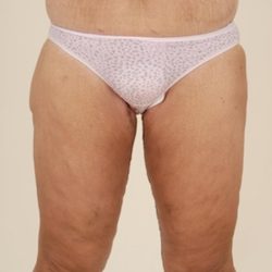 Thigh Lift Before & After Patient #1057