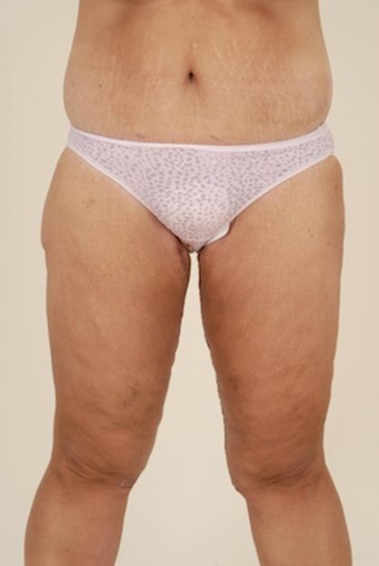 Thigh Lift Before & After Patient #1057