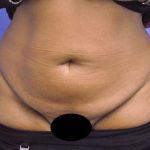 Tummy Tuck Before & After Patient #1541