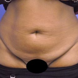 Tummy Tuck Before & After Patient #1541