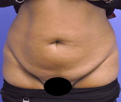 Tummy Tuck Before & After Patient #1541