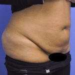 Tummy Tuck Before & After Patient #1541