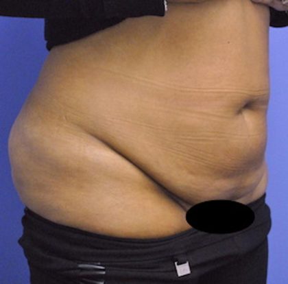 Tummy Tuck Before & After Patient #1541